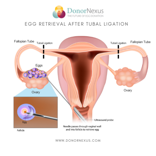 Egg retrieval after tubal ligation. Can you donate eggs if your tubes are tied? Yes, it's possible, and here's why.