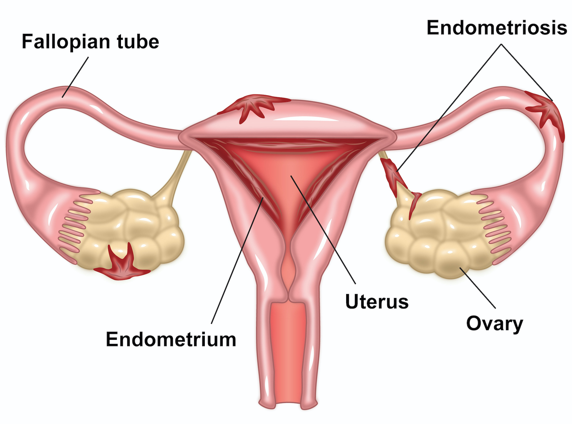 Endometriosis is a chronic condition where tissue similar to the lining inside the uterus grows outside of it, causing pain, inflammation, and sometimes infertility. While some women may experience symptoms like painful periods, fatigue, and intense pelvic pain, others may be asymptomatic (known as “silent endometriosis”), discovered only when facing infertility issues. 