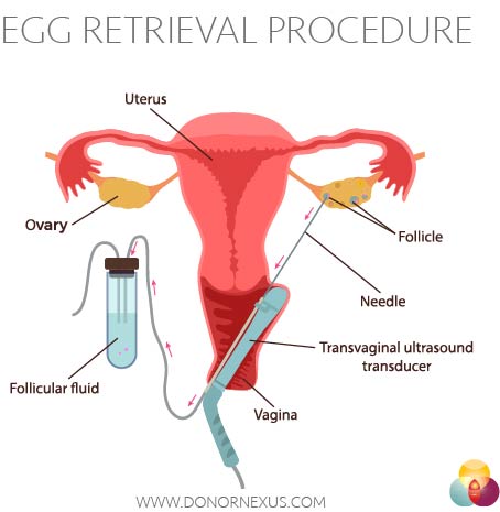 This diagram shows how the egg retrieval procedure works when donating your eggs to be used during IVF.